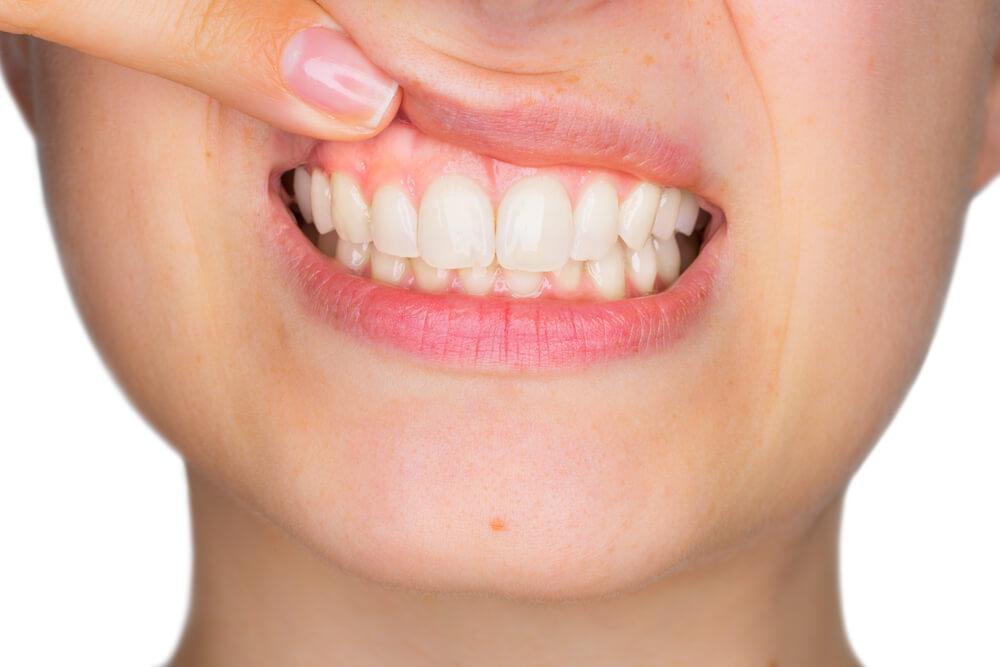 Diş Eti Hastalıklarının Önlenmesi İçin 5 İpucu